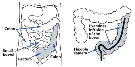 Flexible Sigmoidoscopy South Tees Hospitals Nhs Foundation Trust