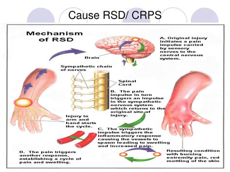 Ppt Reflex Sympathetic Dystrophy Complex Regional Pain Syndrome