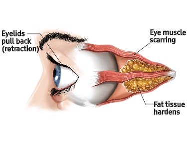 Hyperthyroidism Eyes Before And After