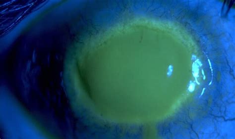 Acanthamoeba Keratitis Storymd