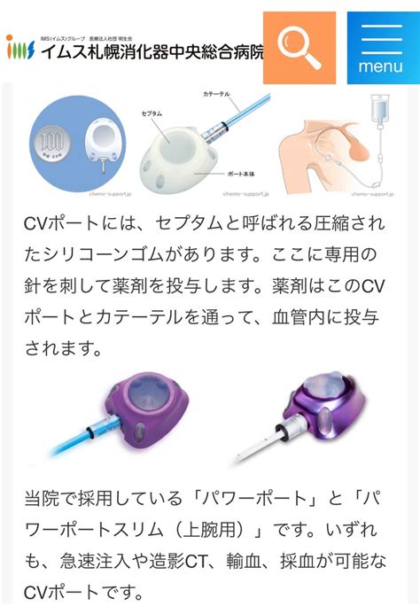CVポート埋設手術受けてきました | 乳ガンステージ2A治療中です♡maのブログ♡