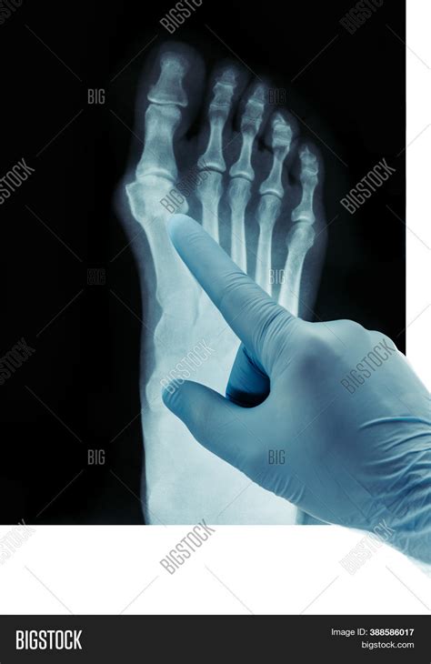 X-ray Feet, Valgus Image & Photo (Free Trial) | Bigstock