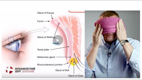 Ячмень. Что делать, как вылечить. Центр Ока - YouTube