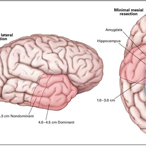 (PDF) A Randomized, Controlled Trial of Surgery for Temporal-Lobe Epilepsy