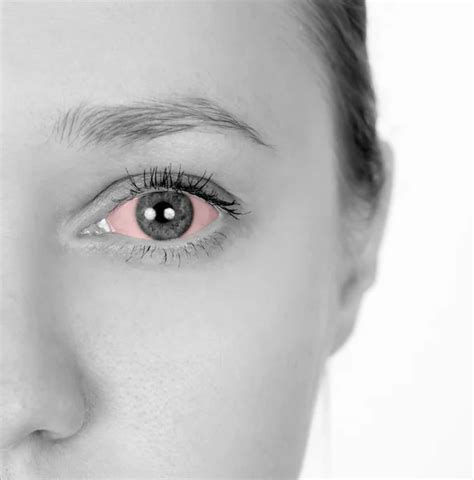 Red eyes allergy Stock Photos, Royalty Free Red eyes allergy Images ...