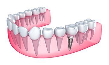 Restore Your Smile With Dental Implants