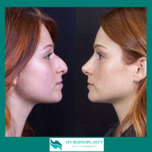 Rinoplastica Chiusa My Rhinoplasty