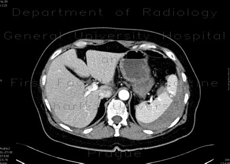 Radiology case: Splenic rupture