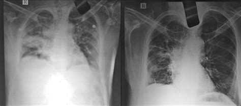 a X-ray of the lungs before treatment (Left Image) b X-ray of the lungs ...