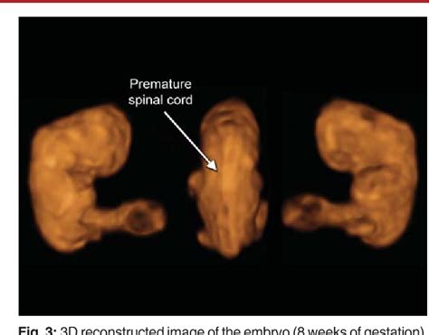 Three Dimensional Four Dimensional Sonography Moved Prenatal Diagnosis Of Fetal Anomalies From