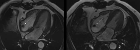 -Figure 2: Cardiac MRI without contrast. Further, evaluation with MRI... | Download Scientific ...