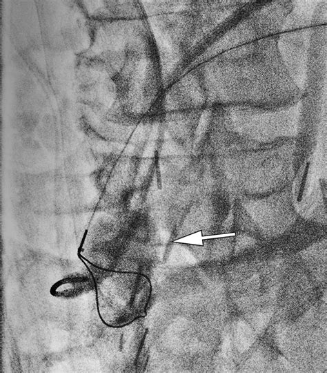 Percutaneous Neoanastomosis Creation For An Ileal Conduit