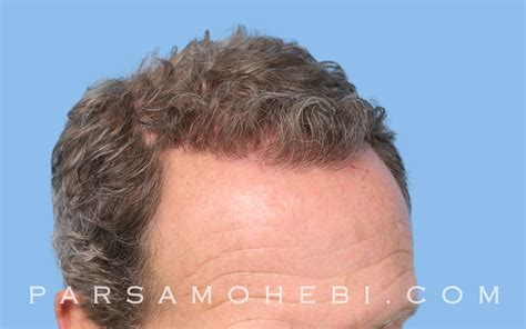 Before And After Fue Hair Transplant 2220 One Procedure 8 Months