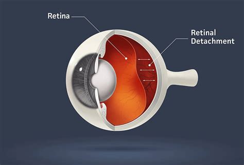 What Is Retinal Detachment Dr Anisha Gupta Eye Specialist