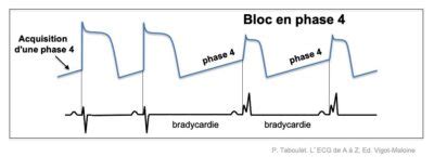 Bloc De Branche Bloc En Phase E Cardiogram