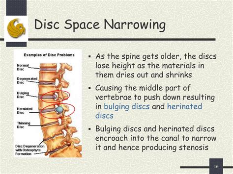 Ppt Computer Aided Diagnosis System For Lumbar Spinal Stenosis Using X Ray Images Powerpoint