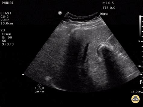 Biliary — Tpa