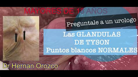 Glandulas De Tyson Puntitos Normales Del Pn Youtube