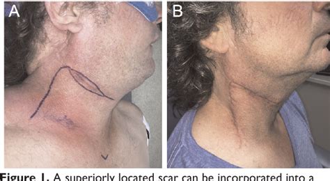 Figure 1 From Definitive Surgical Therapy After Open Neck Biopsy For