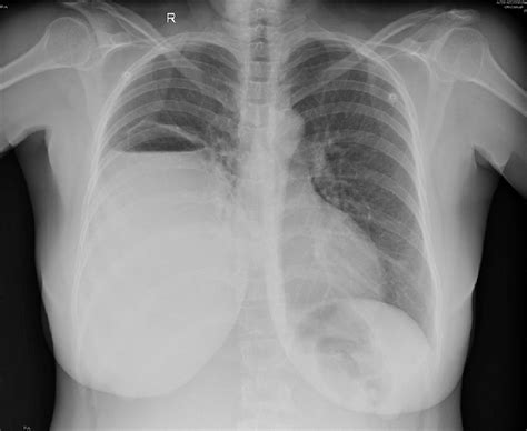 Chest X Ray Hydropneumothorax