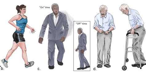 Uf Neurologists Create A New Image Of Parkinson Disease Mcknight