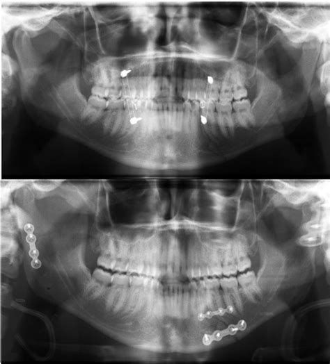 A Panoramic Image Showing Fracture On Left Side At The Intermaxillary Download Scientific