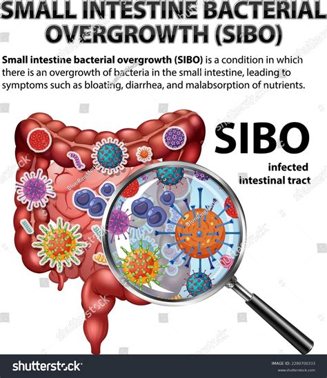 Small Intestine Bacterial Overgrowth Sibo Illustration Stock Vector