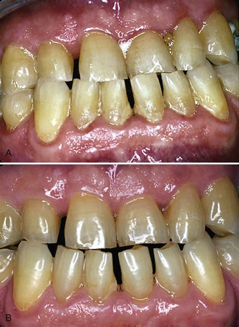 Periodontal Treatment Phases