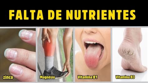 20 Sinais E Sintomas De Falta De Nutrientes Importantes Vitaminas E