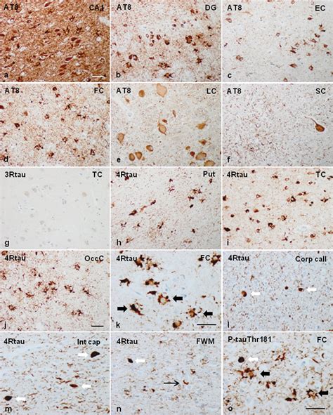 Representative Neuropathological Alterations In Ggt Linked To Mapt