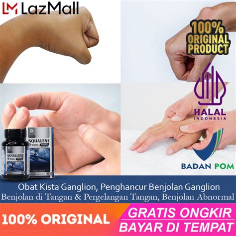 Bio Squalene Obat Kista Ganglion Penghancur Benjolan Ganglion