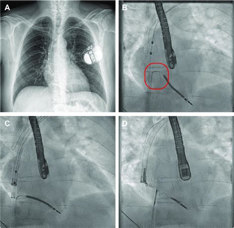 A The Chest Radiograph Demonstrating The Position Of The Targeted