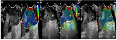 Frontiers Contrast Enhanced Ultrasound Combined With Elastic Imaging