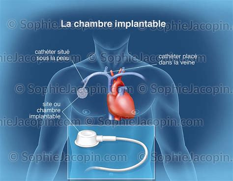 Chambre Implantable Illustration Sophie Jacopin