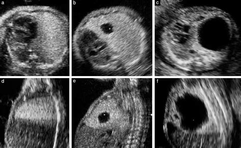 Prenatal Diagnosis And Outcome Of Echogenic Fetal Lung Lesions