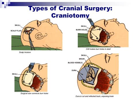 PPT Care Of The Client With Cranial Surgery PowerPoint Presentation