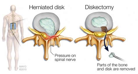 Slip Disc How Does It Happen Gordon Macleod