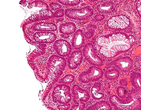 Quiz Gastrointestinal Polyps 1 Libre Pathology