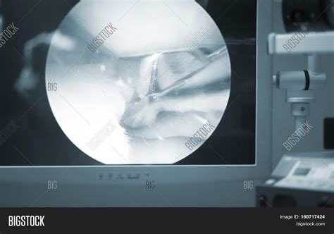 Arthroscopy Surgery Image & Photo (Free Trial) | Bigstock