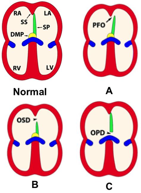 Group 2 Presentation 3 Atrial Septal Defect Wiki