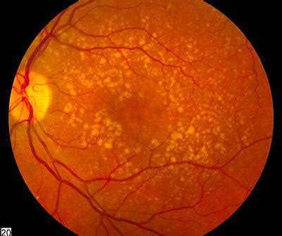 Eye Doctor Seattle Eye Care Eye Associates Northwest Blog