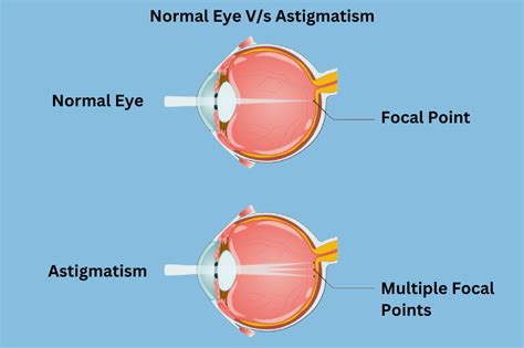 Astigmatism Everything You Need To Know