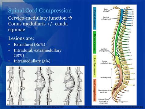 PPT - Spinal Cord Compression PowerPoint Presentation, free download - ID:1763209