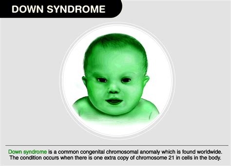 Down Syndrome: Facts, Types, Diagnosis & Characteristics