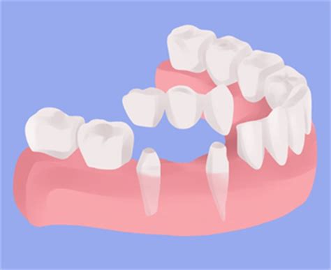 What Does A Dental Bridge Look Like Picture Credit To Queensway Dental Newcastle Upon Tyne