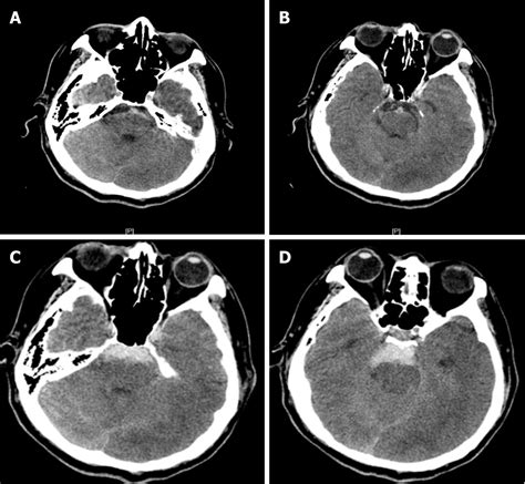 Recurrent Perimesencephalic Nonaneurysmal Subarachnoid Hemorrhage