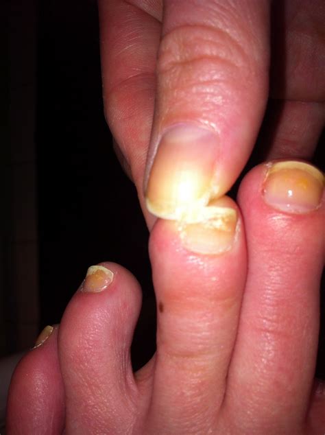 how to fix broken toe nail