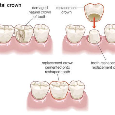 Crown and Bridge | Geetanjali Dental Options