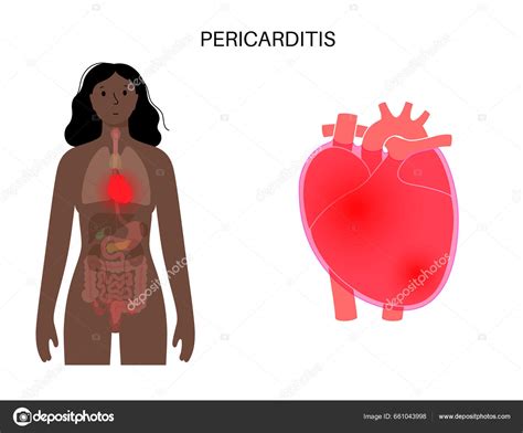 Cartel Anatómico Pericarditis Inflamación Pared Síntoma Dolor Torácico