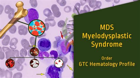 Myelodysplastic Syndrome (MDS) | Genomic Testing Cooperative